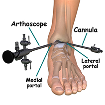 Ankle Arthroscopy Surgery