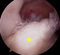 Arthroscopy Surgery Arthroscopy Surgery
