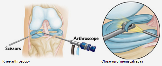 Arthroscopy Surgery