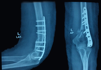 Trauma Centre for Accidental Surgery in Ahmedabad, Gujarat, India