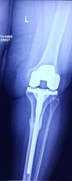 Knee Replacement