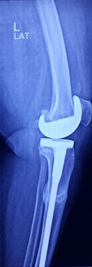 Knee Replacement