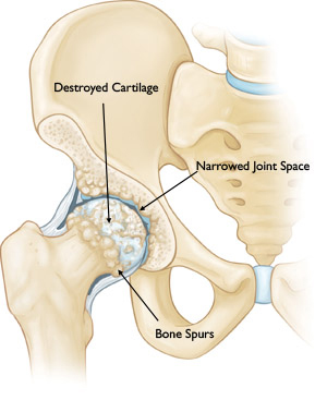 Total Hip Arthroplasty