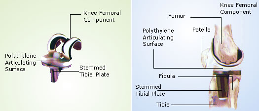 Revision Joint Replacement