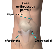 Knee Arthroscopy Surgery Knee Arthroscopy