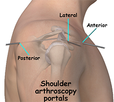 Shoulder Arthroscopy Surgery Shoulder Arthroscopy