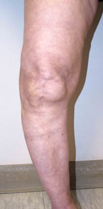 Total Knee Arthroplasty in Ahmedabad, Gujarat, India
