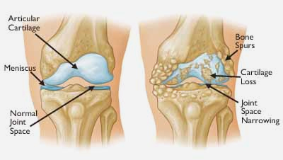 Total Knee Replacement