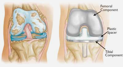 Total Knee Replacement Total Knee Replacement