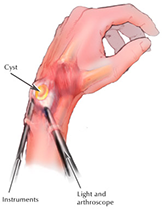 Wrist Arthroscopy Surgery