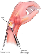 Wrist Arthroscopy Surgery Wrist Arthroscopy Surgery